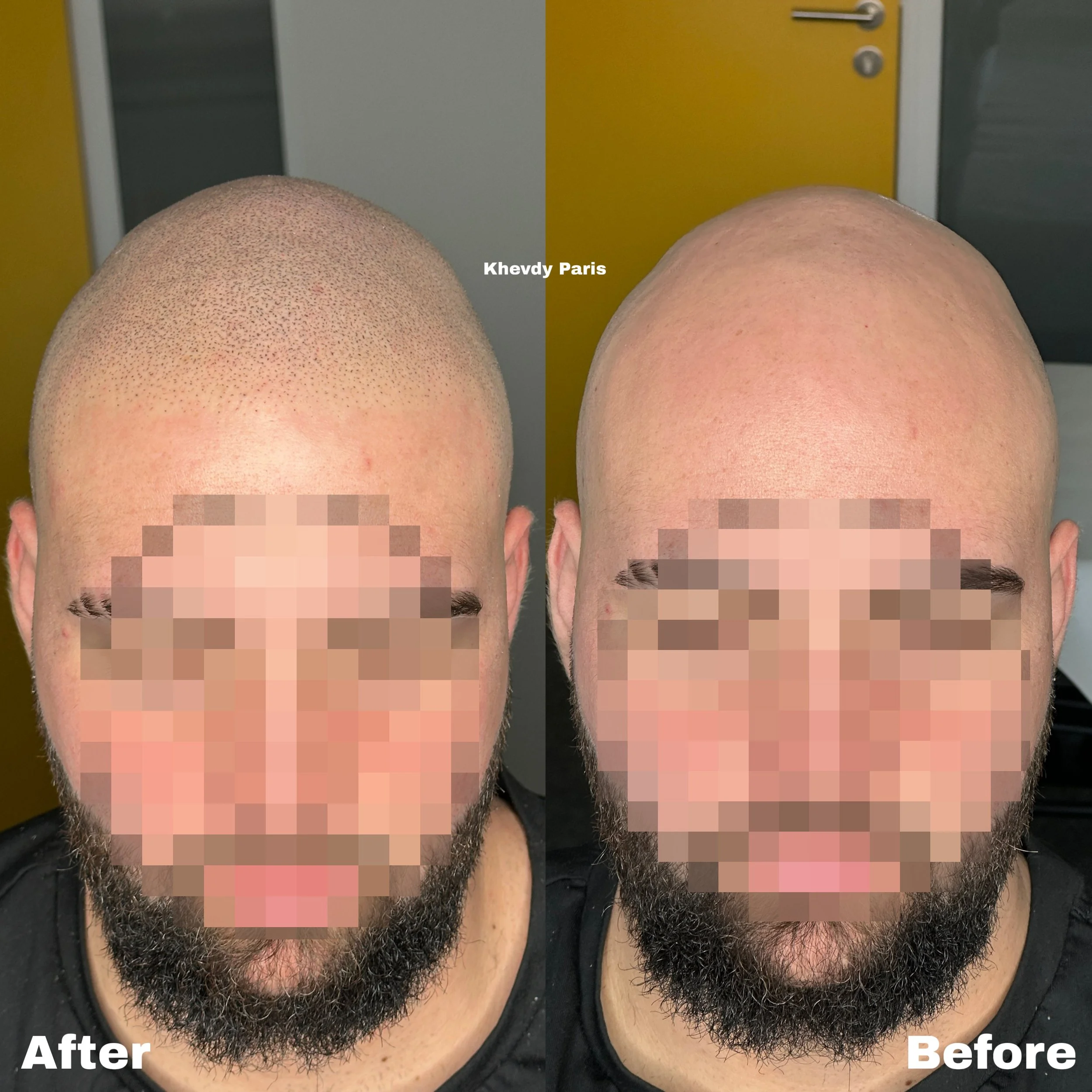 Comparison of a man's scalp showing before and after hair transplantation. The left side labeled 'After' displays a full head of hair, while the right side labeled 'Before' shows baldness.