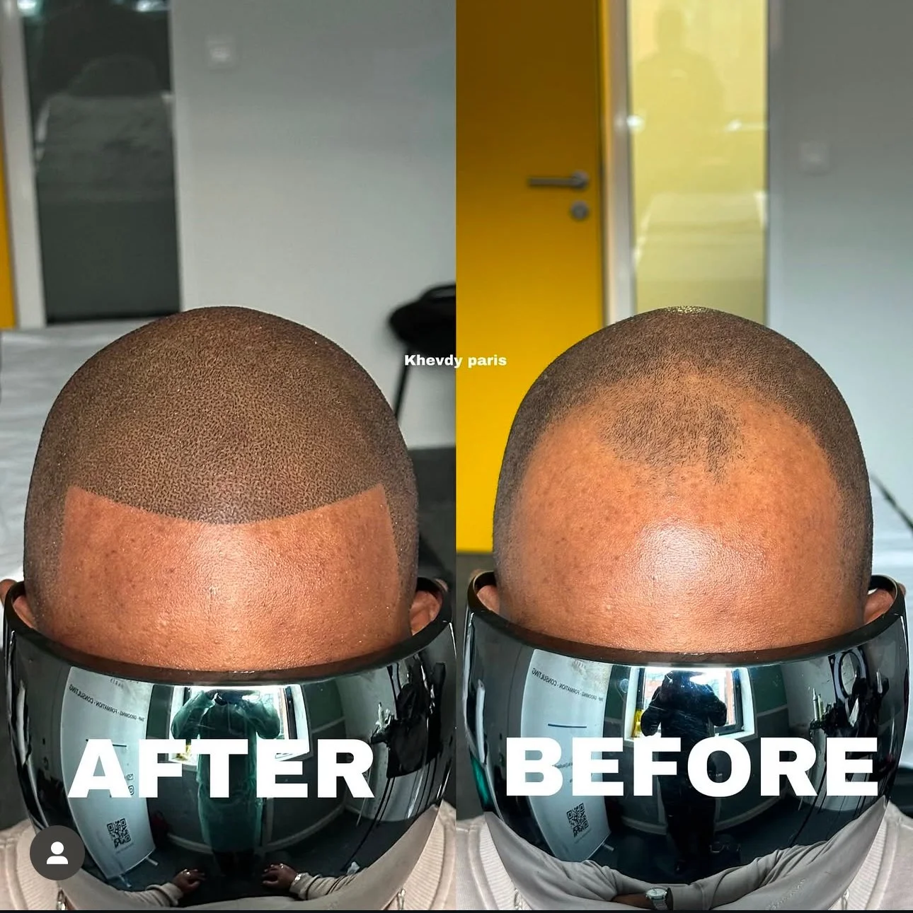 Comparaison des résultats de tatouage de cheveux, gauche après la procédure, droite avant, avec un casque de protection refletant la room.