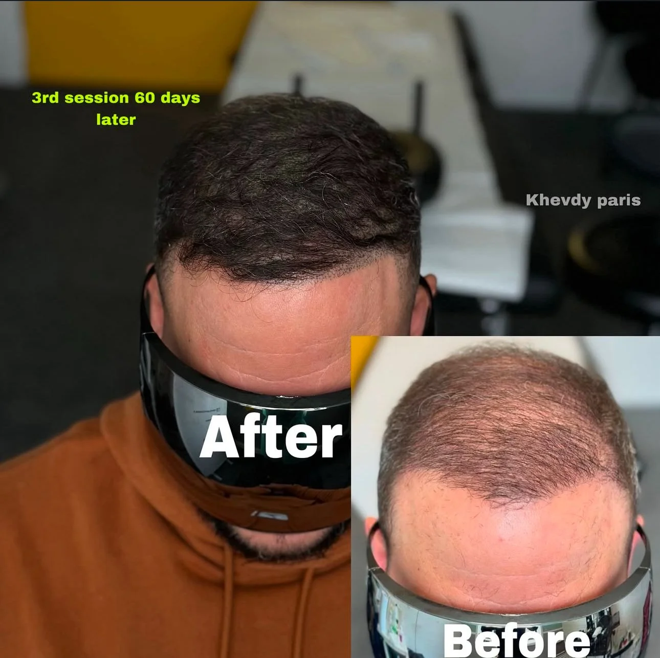 Comparison avant et après d'une greffe de cheveux sur un homme, avec le texte 'Before' sur la photo inférieure et 'After' sur la photo supérieure. La photo mentionne '3rd session 60 days later'.