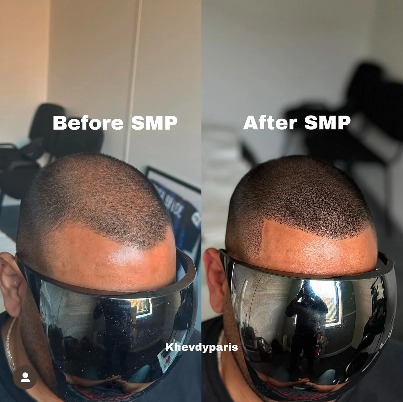 Densité et Contours : Nous ajoutons de la densité sur les zones naturellement clairsemées ou en complément d’une greffe capillaire car en moyenne il y a 30% de perte de greffons. Teinte, intensité et le look esthétique du pigment sont ajustées avec p