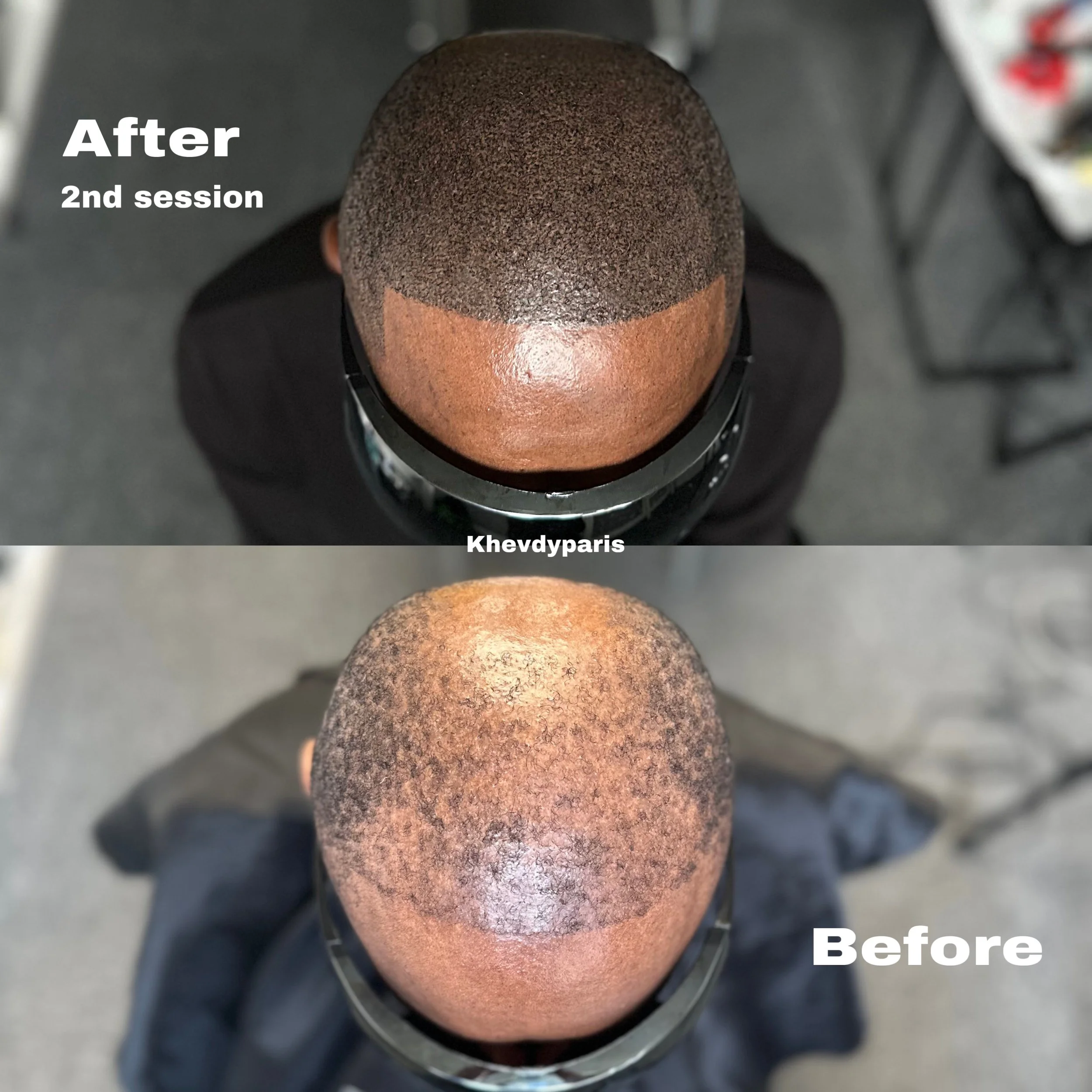 SMP après l'échec de la greffe pour satisfaire le besoin de notre qui souhaitait des résultats efficaces et fiables ! 