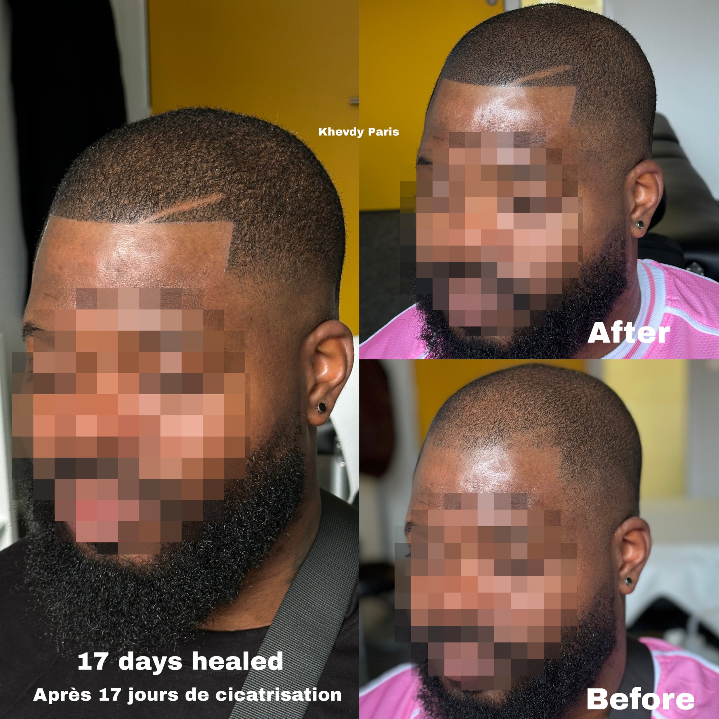 Progression de la cicatrisation d'une tête rasée avec une barbe, montrant l'avant, après 17 jours de cicatrisation, et un aperçu du résultat final. La photo met en évidence la guérison d'une peau après une procédure de rasage ou de traitement capilla