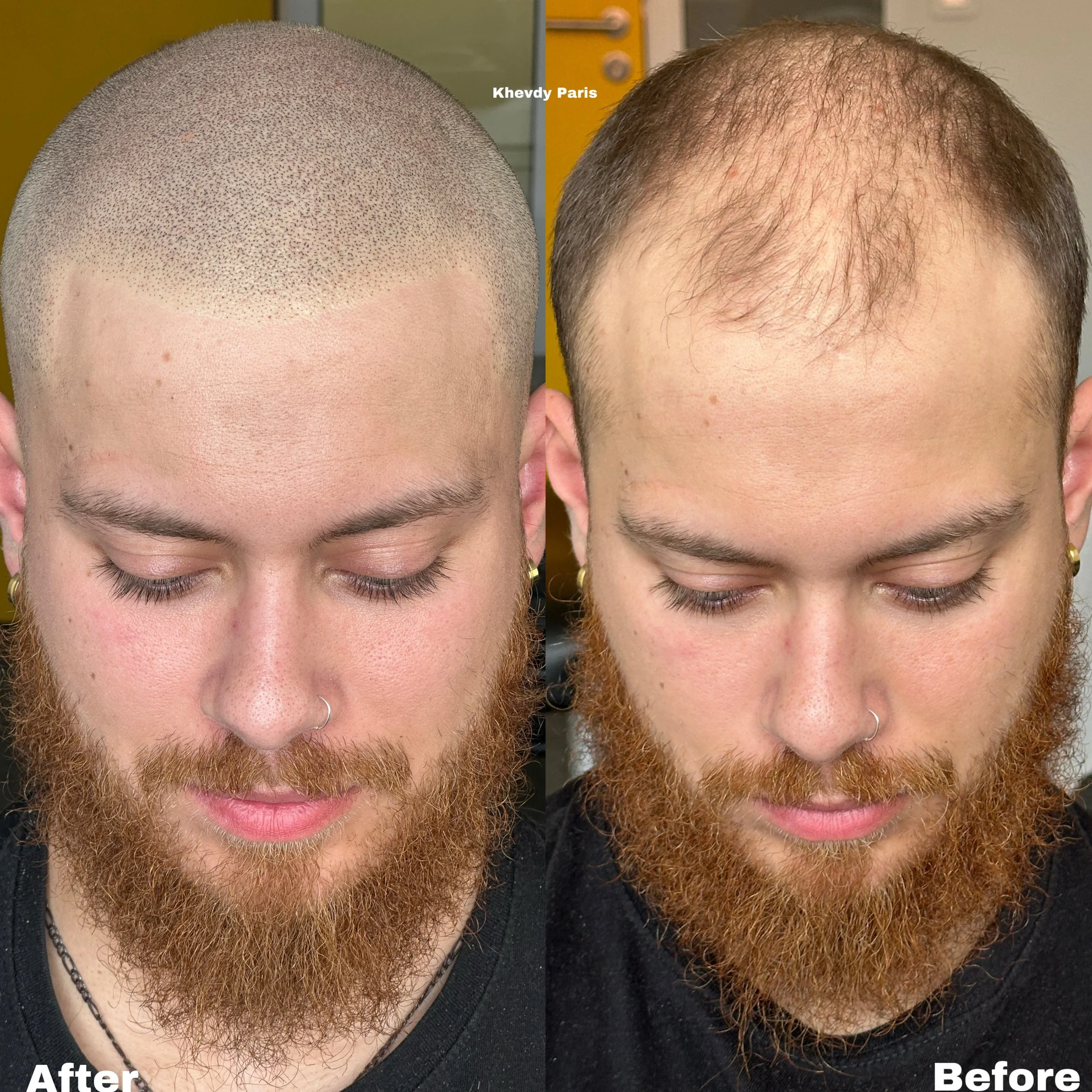 Effet rasé style européen. Retrouvez un look homogène et naturel, efficace contre la calvitie à tous les stades. Quel que soit le niveau d’évolution, notre approche sur mesure garantit un résultat optimal, avec un suivi personnalisé sur plusieurs moi