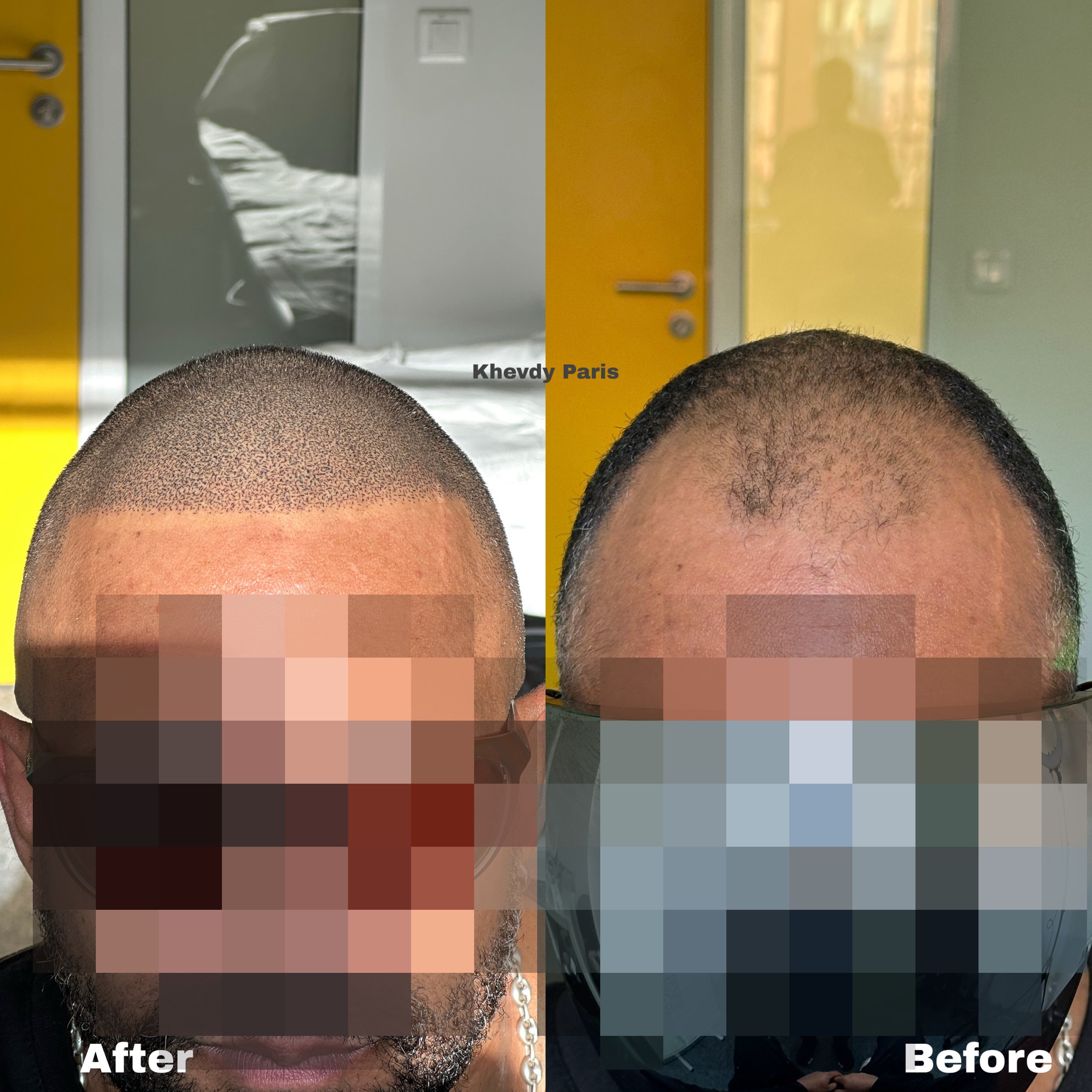 Photo comparant les résultats d'une greffe de cheveux. À gauche, un homme avec une nouvelle coiffure, cheveux très rasés, après la greffe. À droite, la même personne avant la greffe, avec une calvitie plus évidente. Fond jaune et porte une chaîne en 