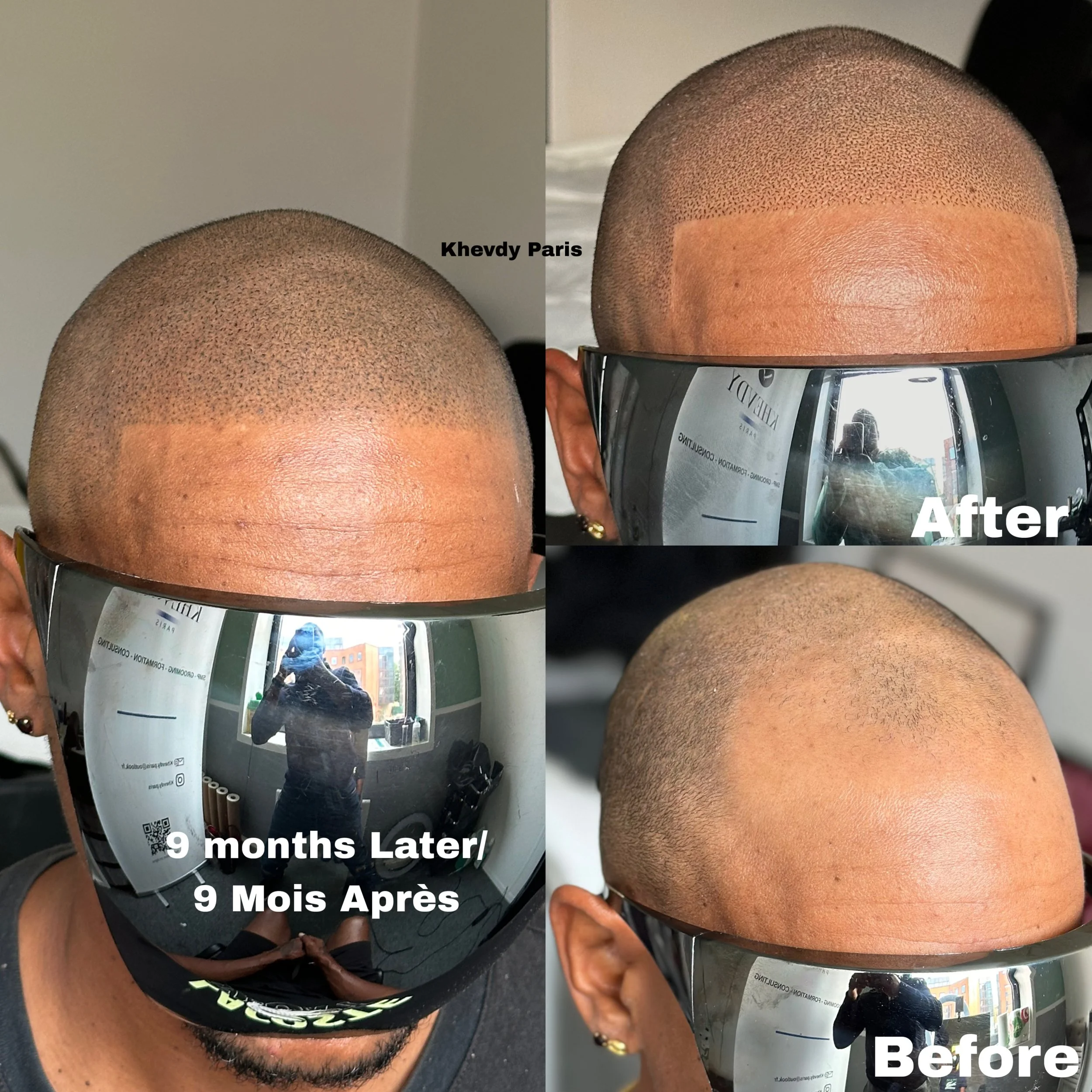 Images montrant un homme avec une coiffure rasée, en provenance d'un avant et après de 9 mois, en se reflétant dans des lunettes de soleil. La photo inclut du texte en anglais et en français indiquant "Before" et "9 months Later / 9 Mois Après" avec 