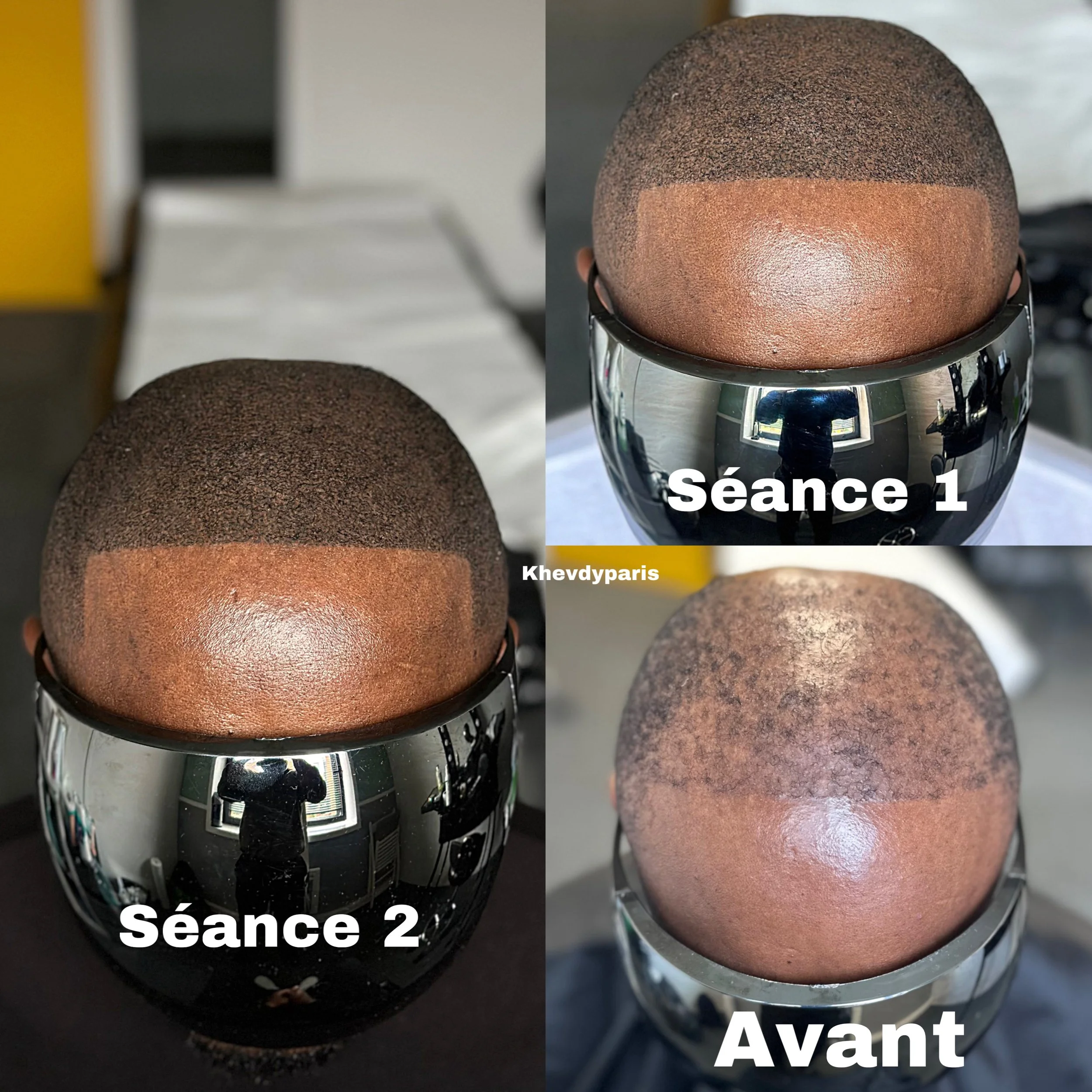 SMP après l'échec de la greffe pour satisfaire le besoin de notre qui souhaitait des résultats efficaces et fiables ! 