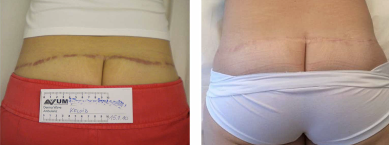 Comparison of a person's lower back and buttocks showing a surgical scar from a tummy tuck, before and after healing.
