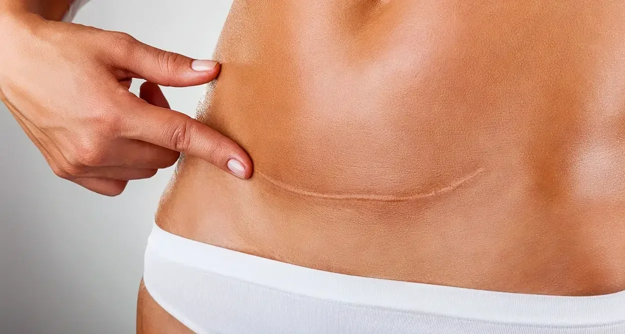 Close-up of a woman pointing to a scar on her lower abdomen, with smooth skin and wearing white underwear.
