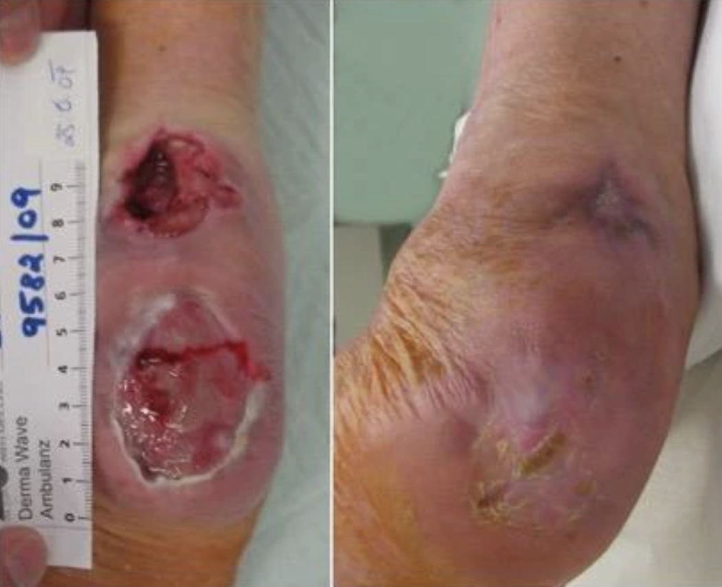 Comparison of an infected, ulcerated wound on a person's arm on the left and the same arm after healing on the right.