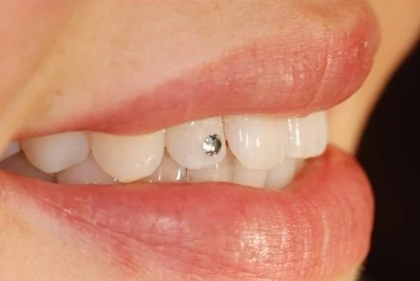 Close-up of a person's mouth showing their teeth with a small rhinestone embedded in one tooth.
