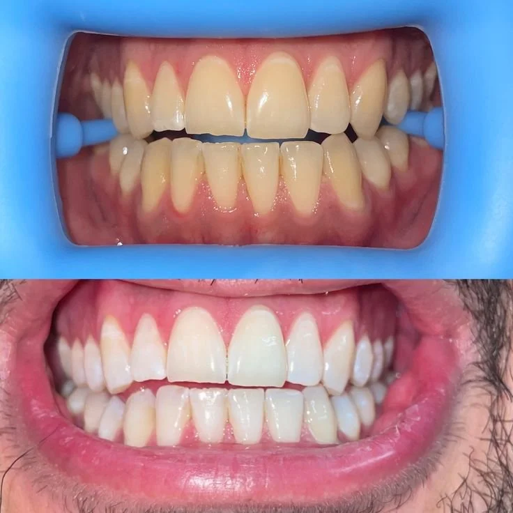 Close-up of a person's mouth showing teeth before and after dental treatment, with a dental cheek retractor in the top image.