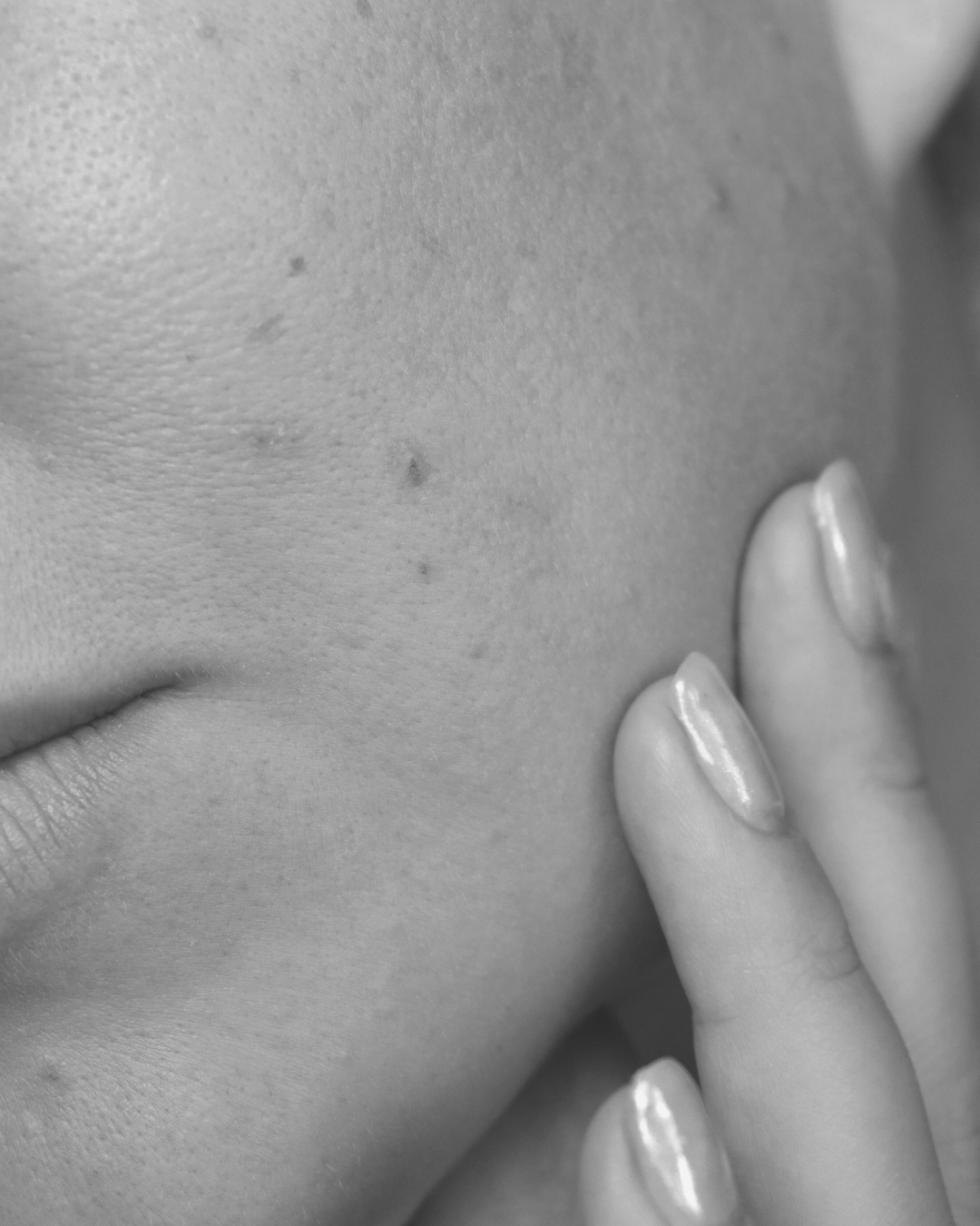 Why Acne Care Has to Include Healing — Not Just Clearing