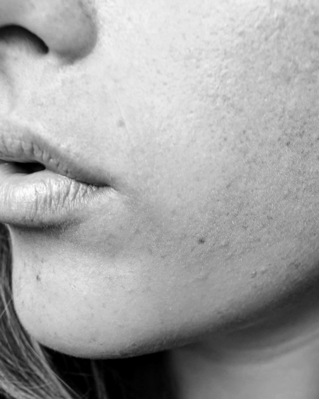 Signs You’re Over-Treating Acne (Sometimes Less is Really More)