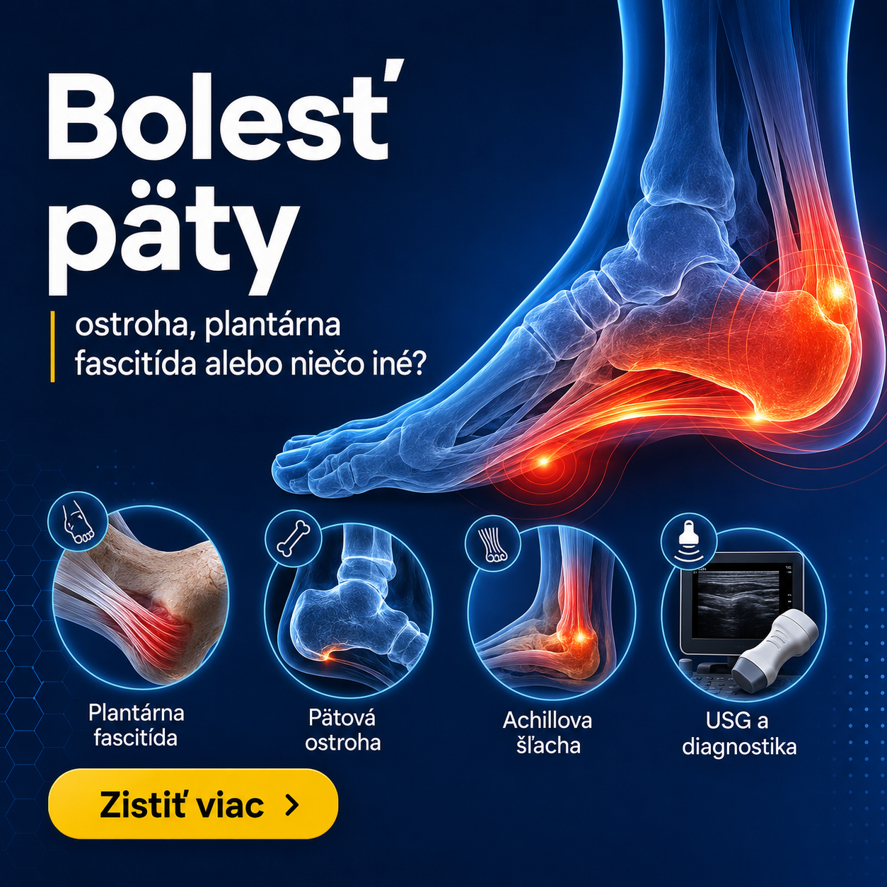 Bolesť päty: ostroha, plantárna fascitída alebo niečo iné?