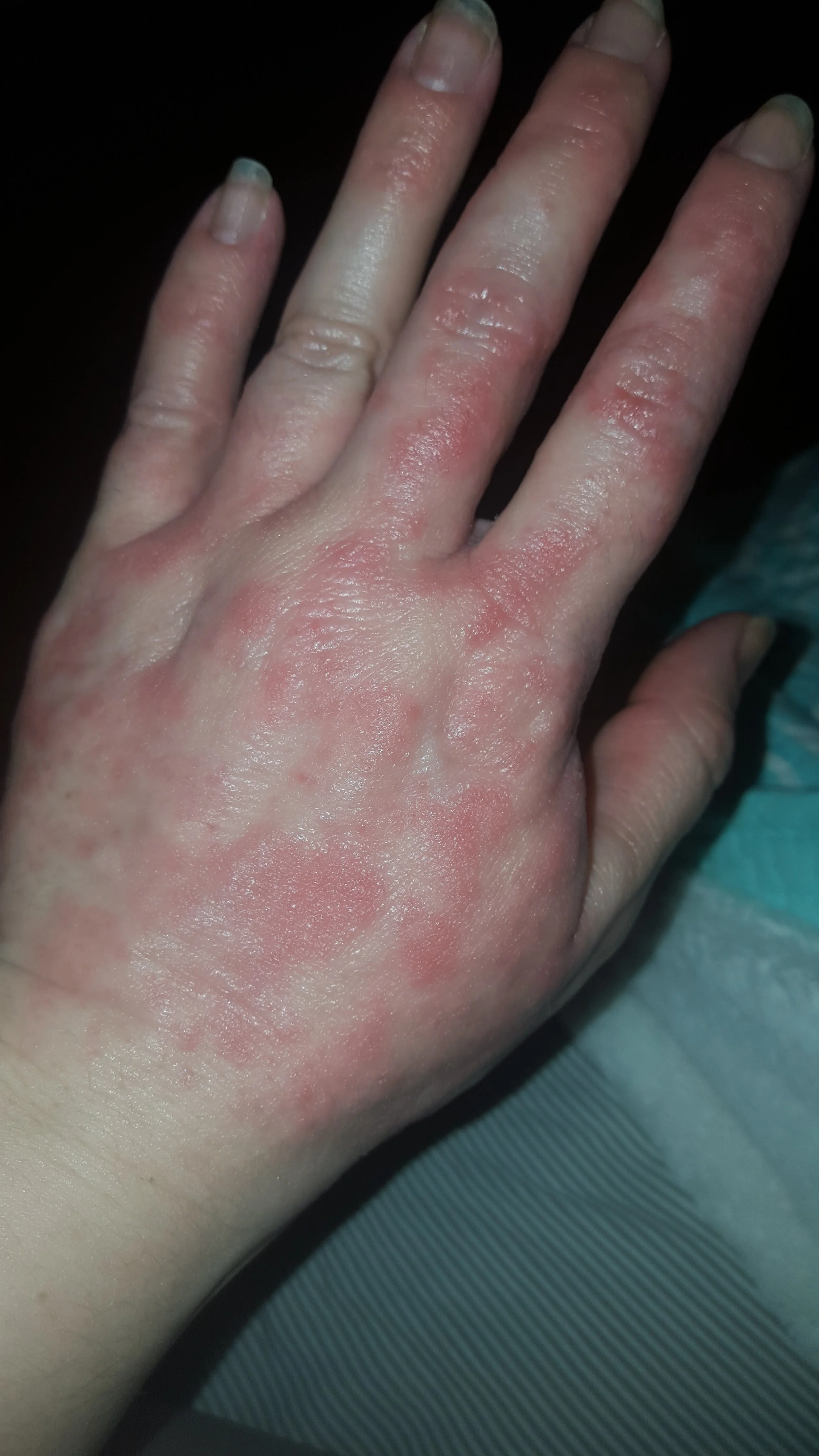 Jaymee's Eczema 3.jpg
