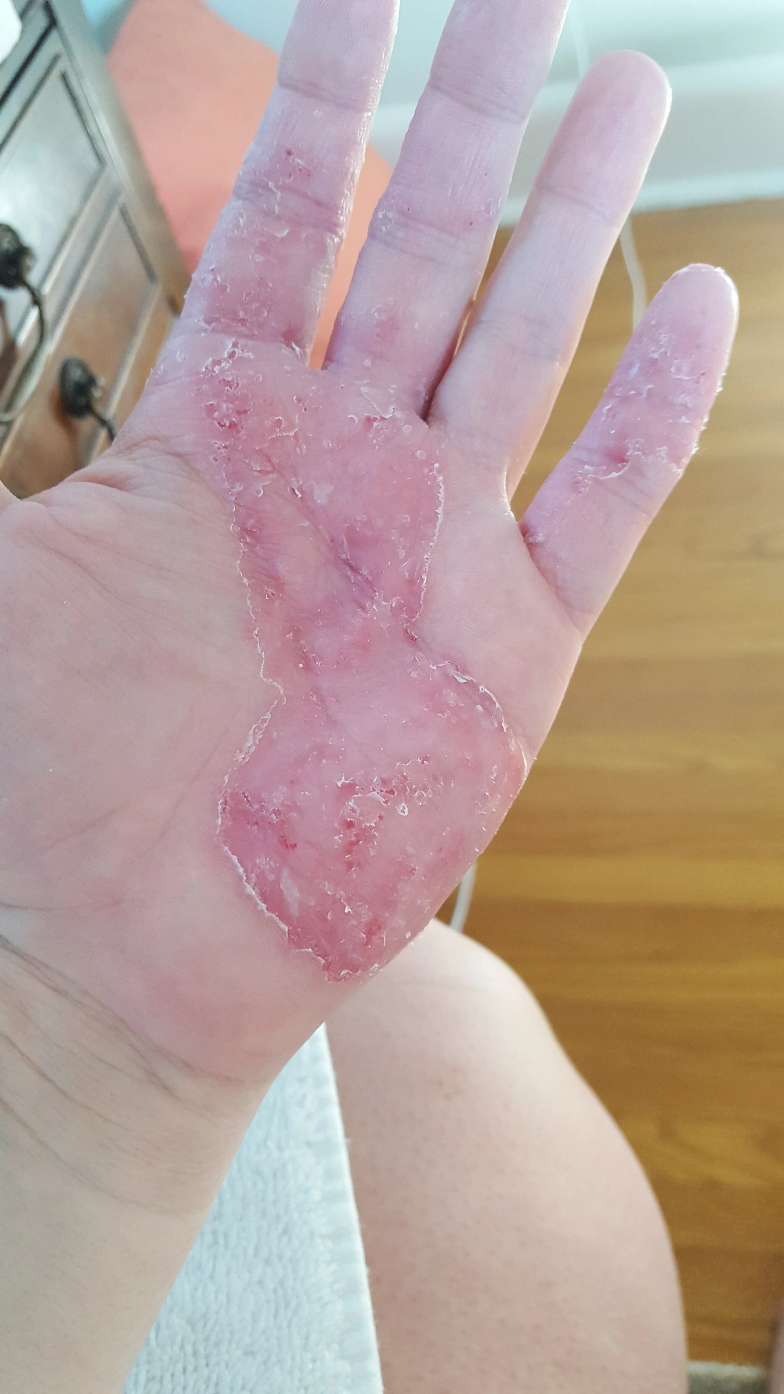 Jaymee's Eczema 4.jpg