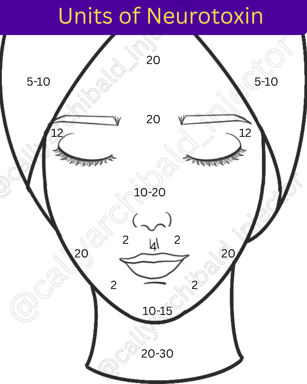 Diagram showing different units of neurotoxin on a face chart, with numbered sections indicating specific areas for treatment.