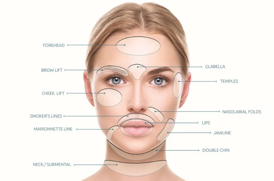 Diagram of a woman's face with labels pointing to different facial areas, including forehead, eyebrow lift, cheek lift, smoker's lines, marionette line, neck/submental area, glabella, temples, nasolabial folds, lips, jawline, and double chin.