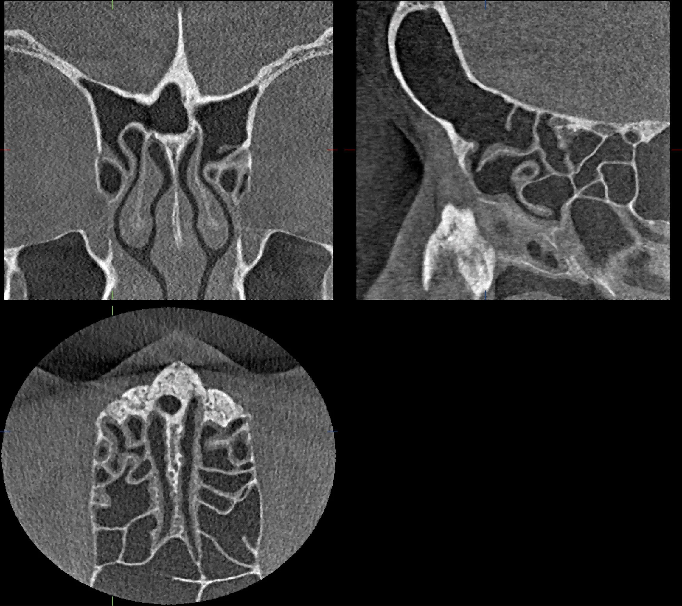 Tomografía de Otorrino.jpg