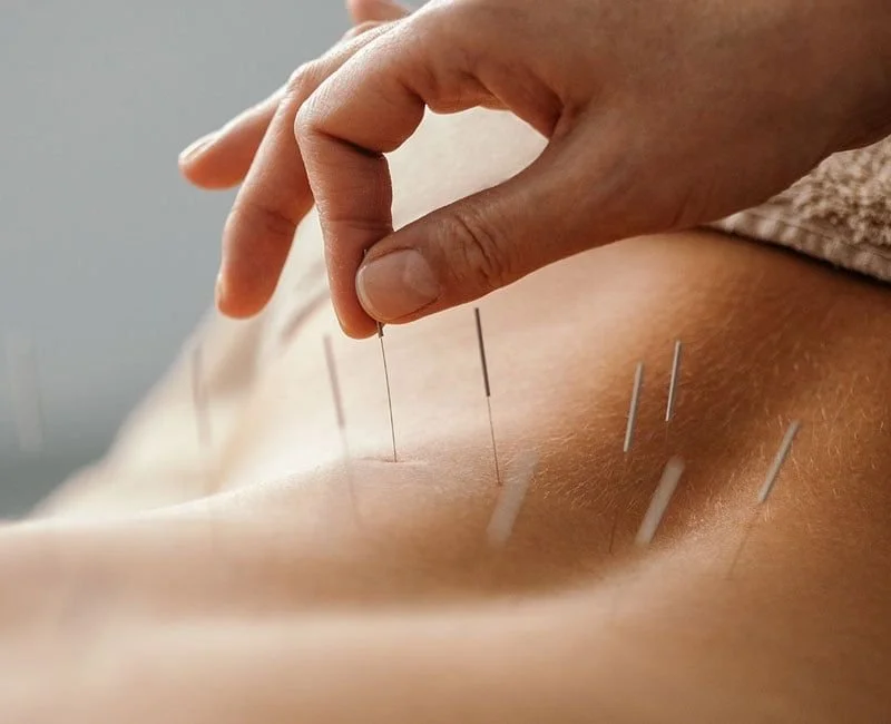 Close-up of a person receiving acupuncture, with several thin acupuncture needles inserted into their skin.