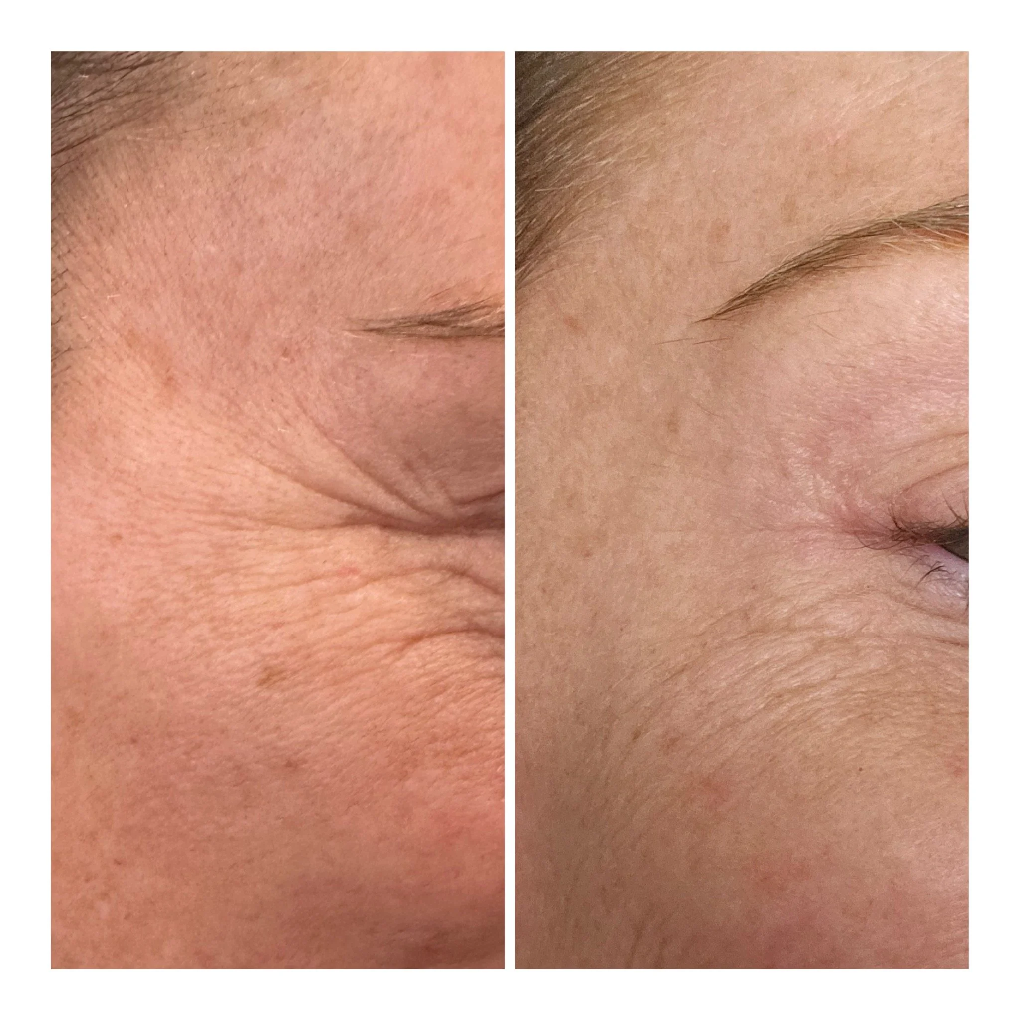 Comparison of skin showing wrinkles on the left and smoother skin on the right.