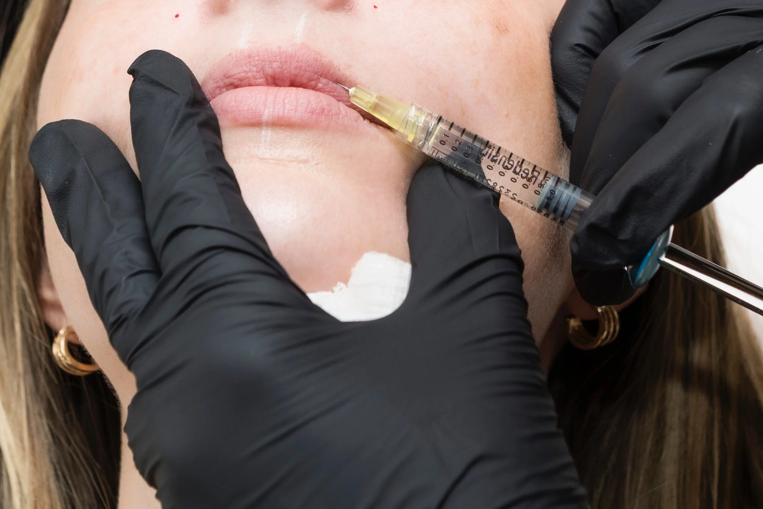 A person with fair skin receiving a cosmetic lip injection from a medical professional wearing black gloves, using a syringe filled with a clear substance near the person's lips.