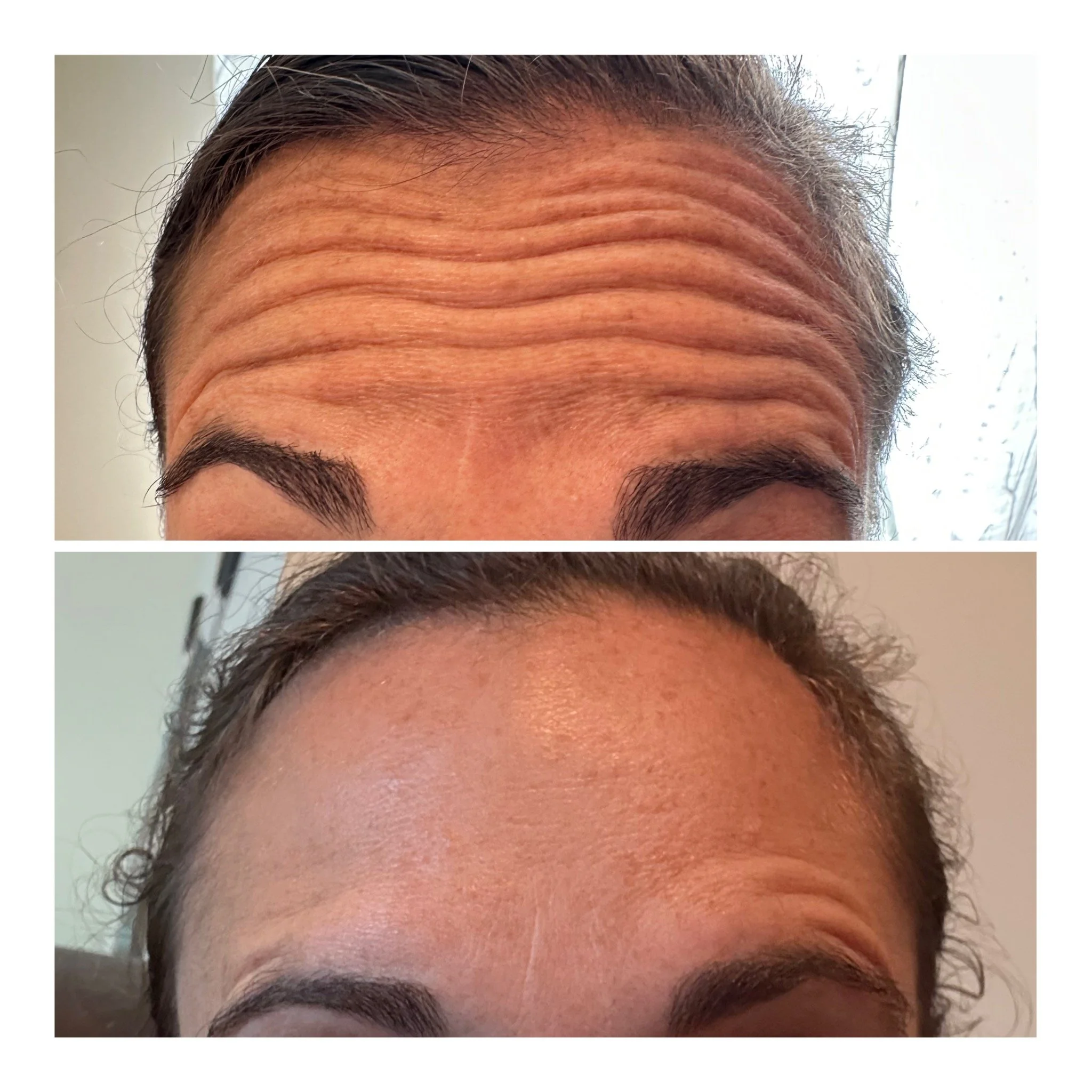 Comparison of forehead before and after cosmetic treatment showing reduced wrinkles.