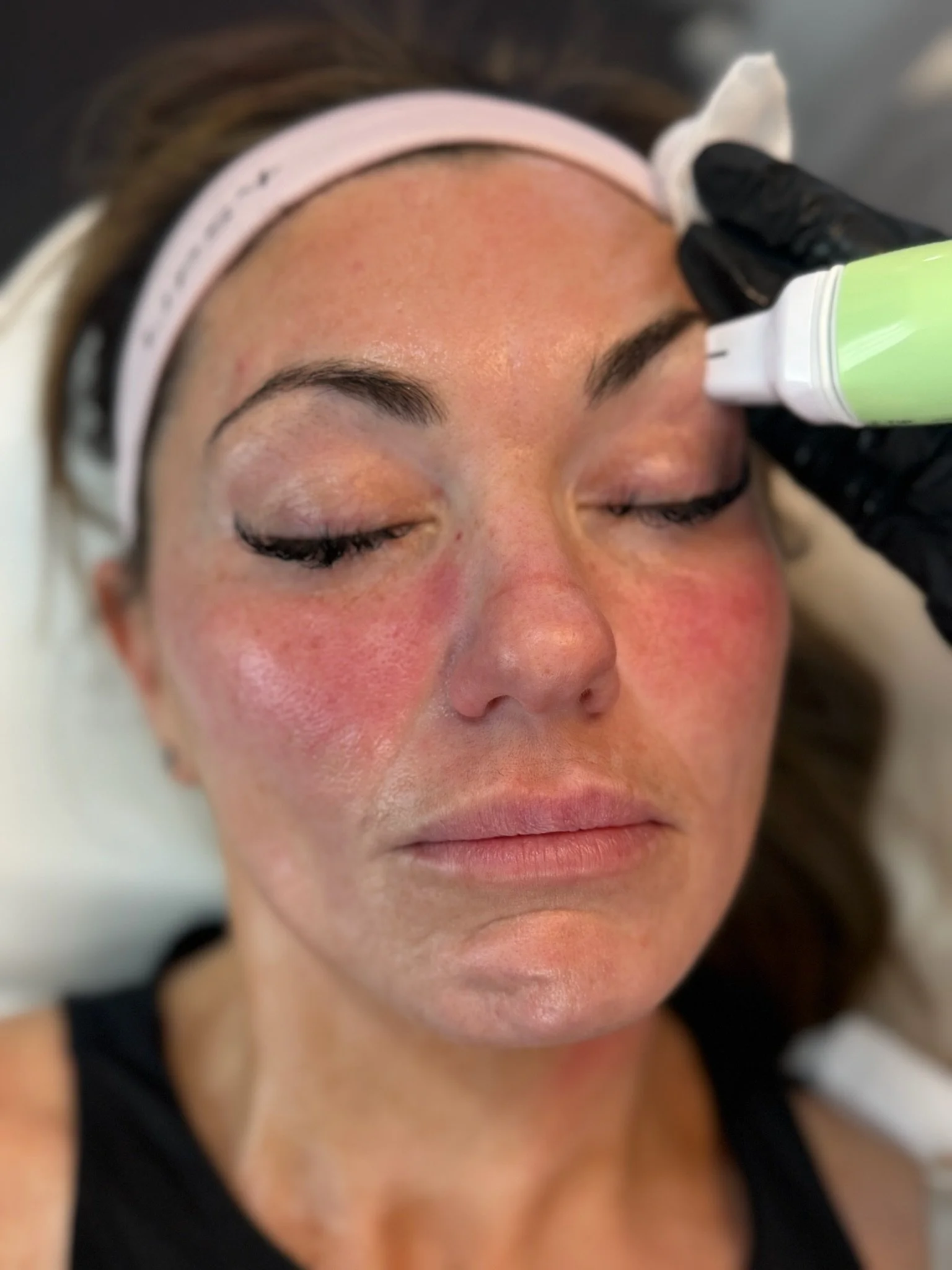 A woman receiving a cosmetic treatment on her face with a green and white device, eyes closed, lying down with head on a pillow, wearing a pink headband and black shirt.