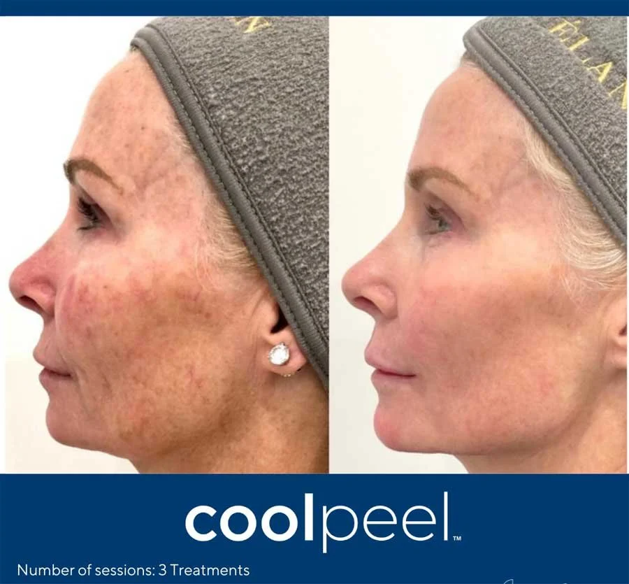 Side-by-side comparison of a woman's face before and after three CoolPeel laser treatments, showing improved skin texture and reduction of pigmentation.