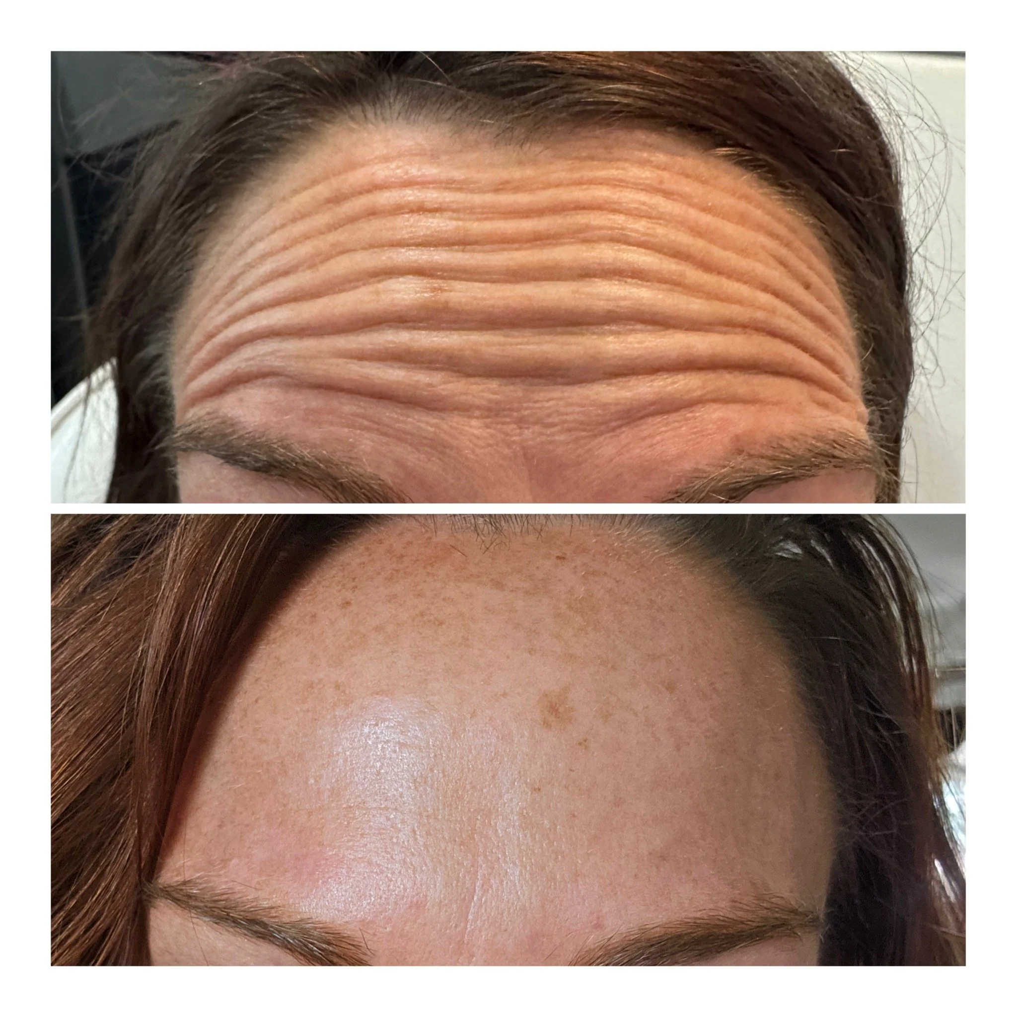 Before and after images showing forehead wrinkles reduced and smooth skin.