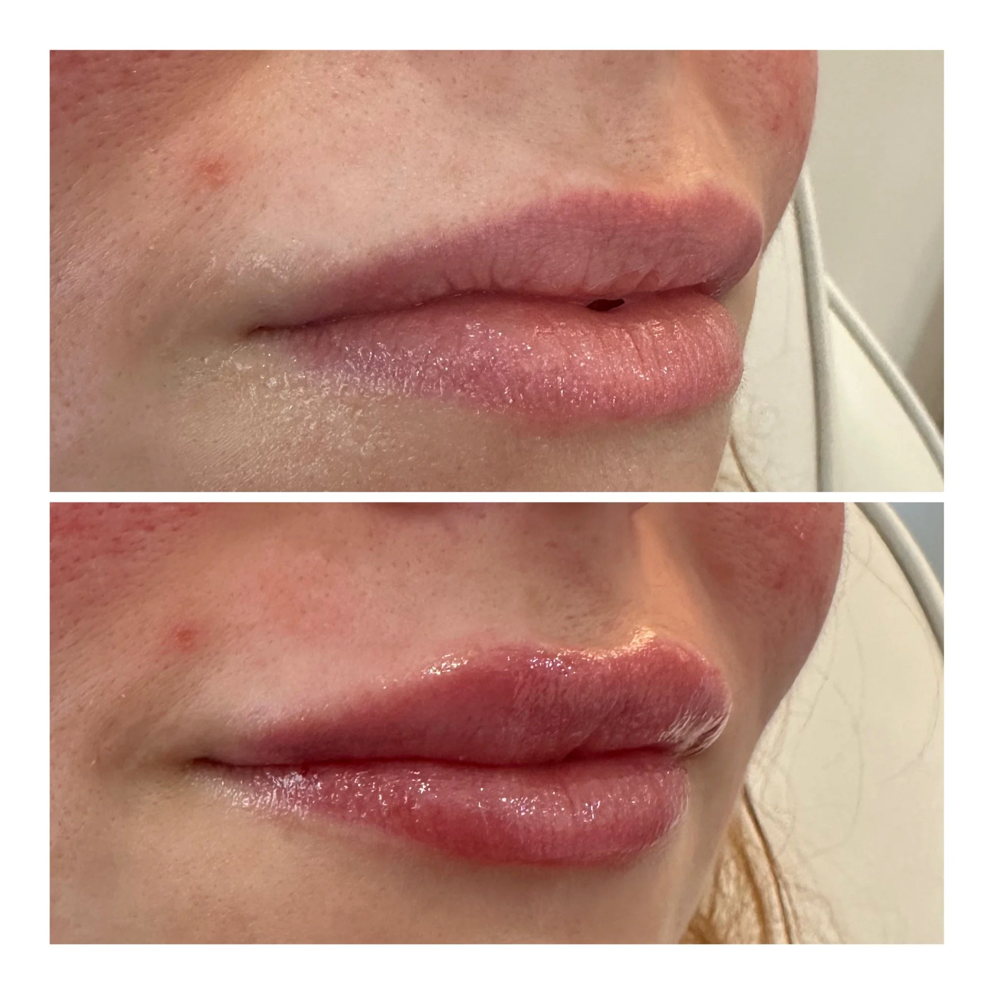 Close-up of a person's lips, showing before and after cosmetic lip enhancement, with the top image displaying natural lips and the bottom image showing fuller, glossy lips.