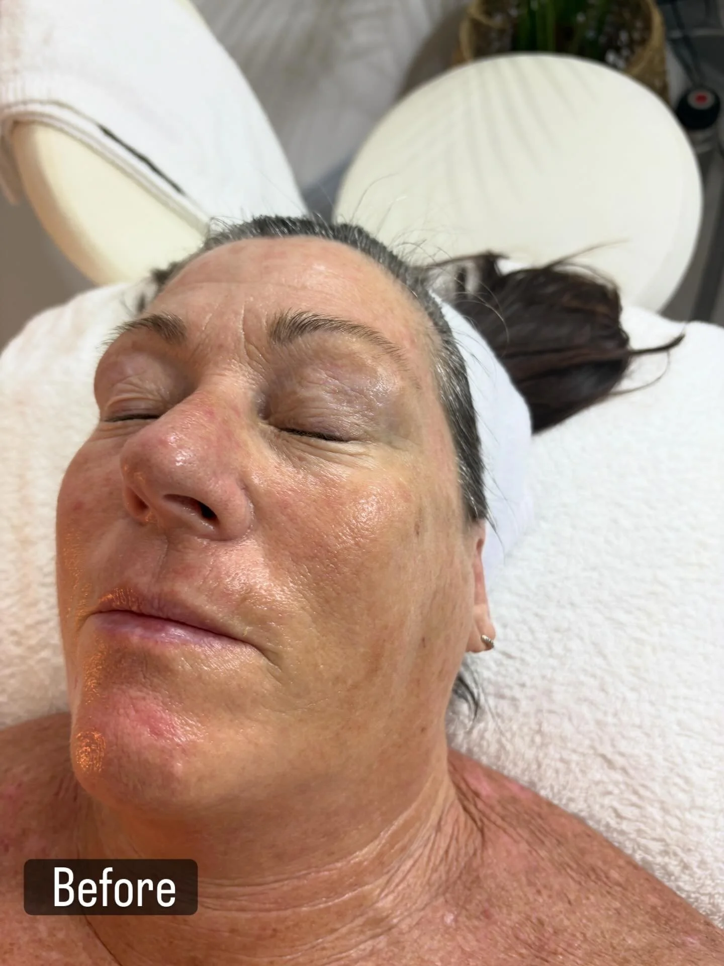 Glow speaks louder than words ✨
Before ➡️ After using the Plump Peel in our Dermalogica Pro 60 Facial 💆&zwj;♀️
Smoother texture, hydrated skin, and that fresh, healthy glow we LOVE 🔥
Results like this don&rsquo;t happen by accident &mdash; they&rsq