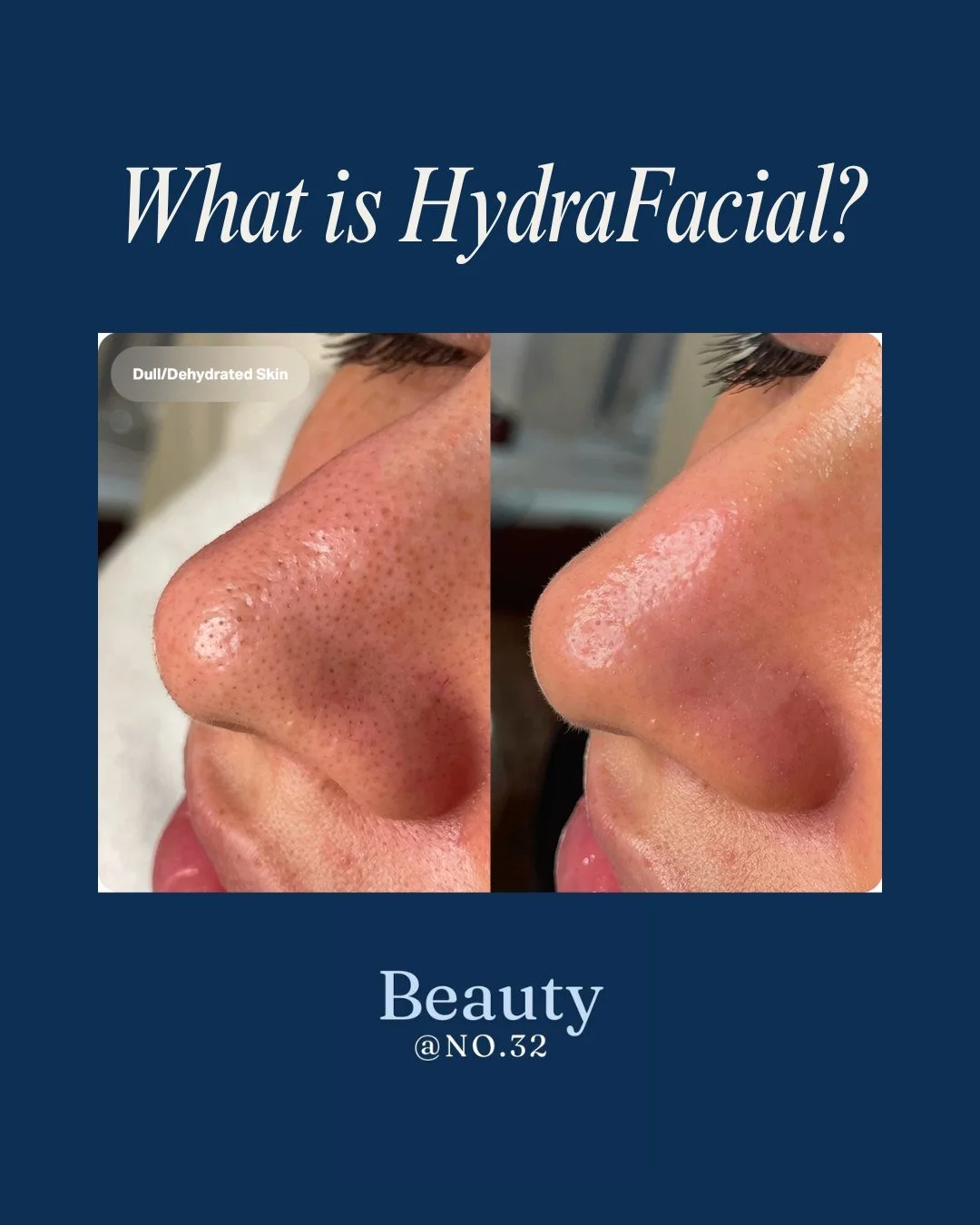 What is HydraFacial&hellip; and why is everyone talking about it?

HydraFacial is an advanced, results-driven facial that works to deeply cleanse, extract, and hydrate your skin &mdash; all in one treatment.

Using a unique vortex technology, it work