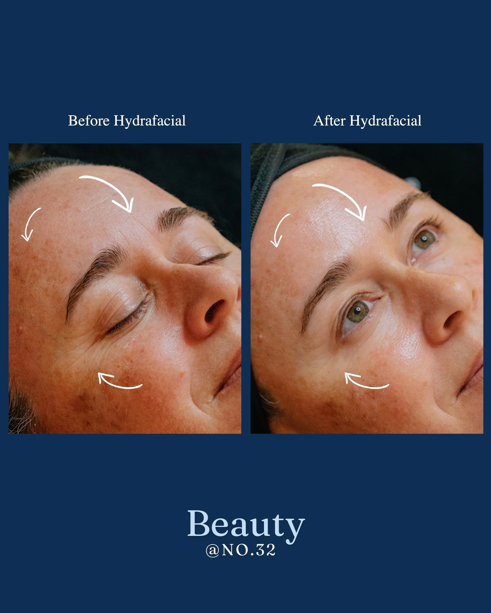 Here is our client&rsquo;s before and after after her first treatment. By tailoring the treatment specifically to her skin type and concerns, we have already started to see improvements in her complexion. As you can see, she has pigmentation across h