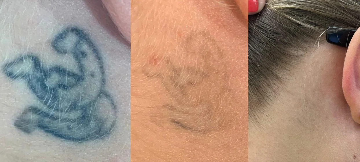 Close-up of three different skin areas with tattoos and scars.