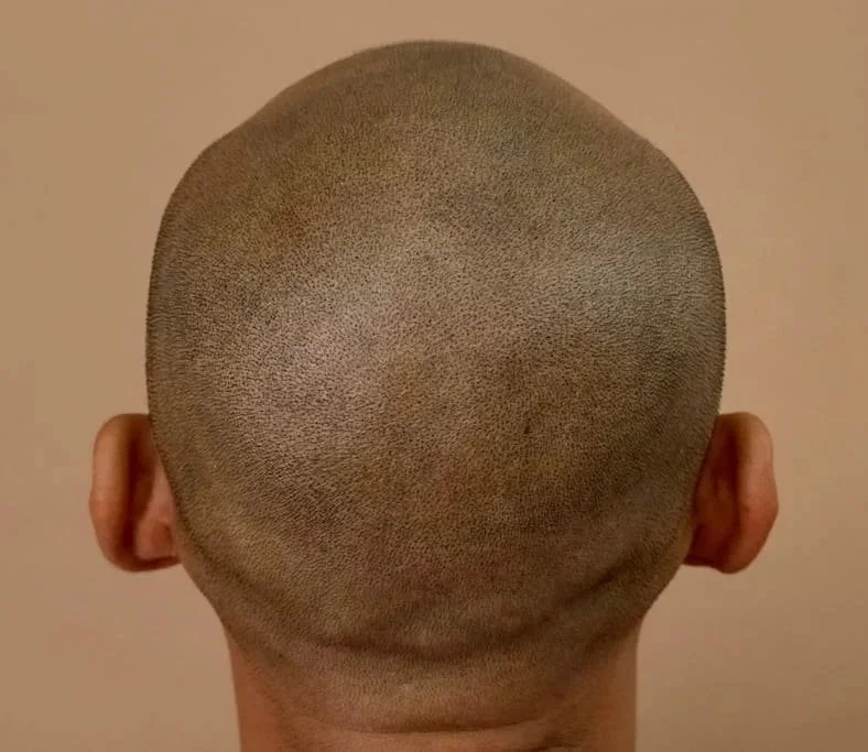 The result of SMP showing a replication of hair follicles. The natural SMP result at URADIANT Sydney