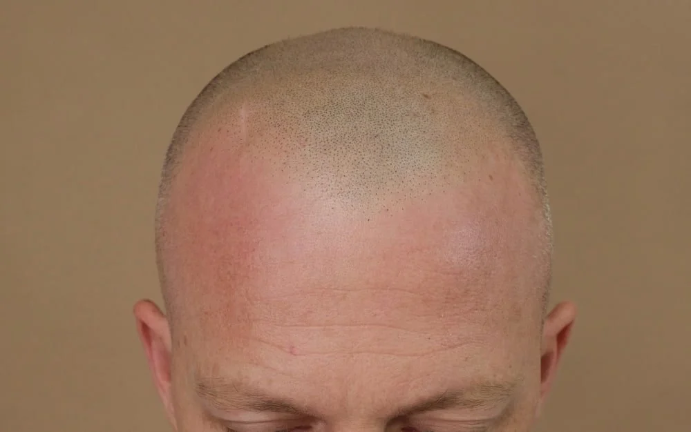 The result of natural hairline design and SMP at URADIANT paddington studio, showing realistic, natural and 3 dimensional result