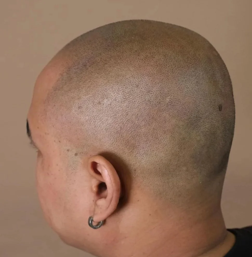 The result of scalp micropigmentation at URADIANT, paddington Studio
