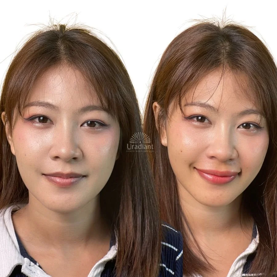 Dark lip neutralisation for women at URADIANT Sydney, paddington studio