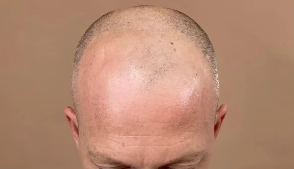 A client who is bald and lost his hair in the frontal scalp and does not wait hair transplant