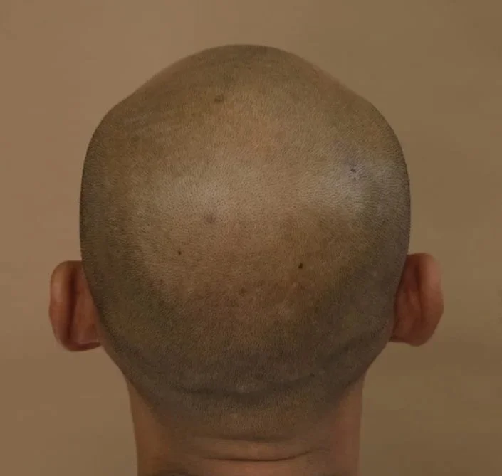 Before SMP procedure, showing a client who lost his hair in the top and vertex area