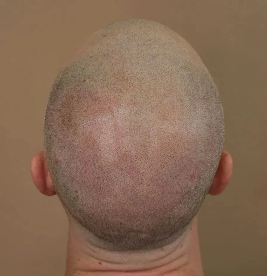 SMP result after 2 sessions using custom pigment and specialise SMP technique providing a complete 3D and natural looks at a Studio in Paddington, NSW