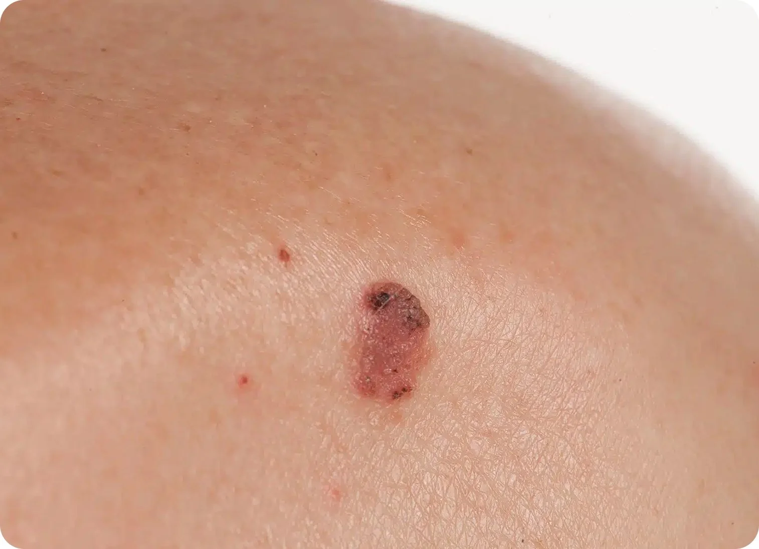 Close-up of human skin with a mole or skin lesion, surrounded by small red pimples.