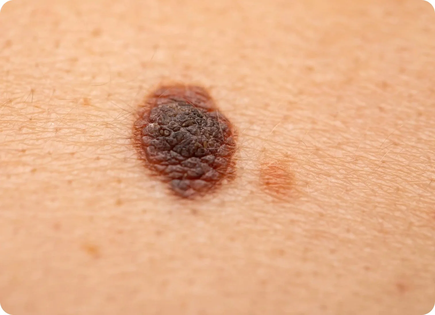 Close-up of a mole with textured, uneven surface on human skin.