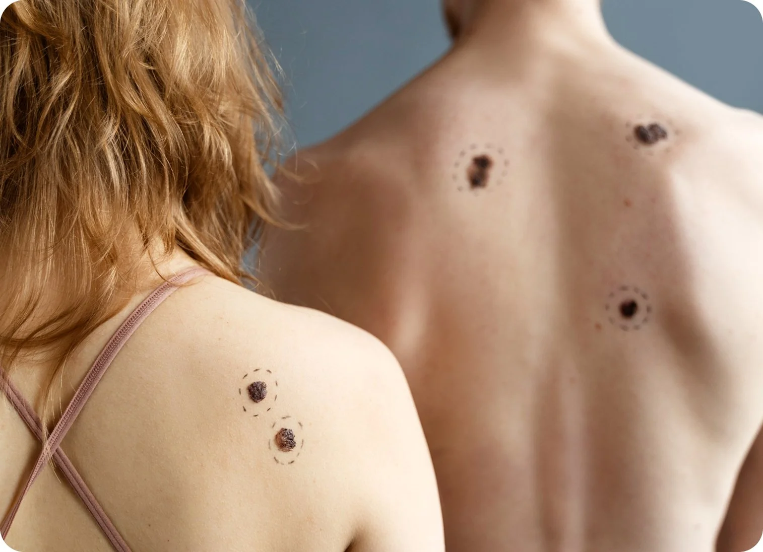 Two individuals with moles on their shoulders. The person on the left has red hair and is wearing a pink strap top, while the person on the right has light skin and no visible clothing.