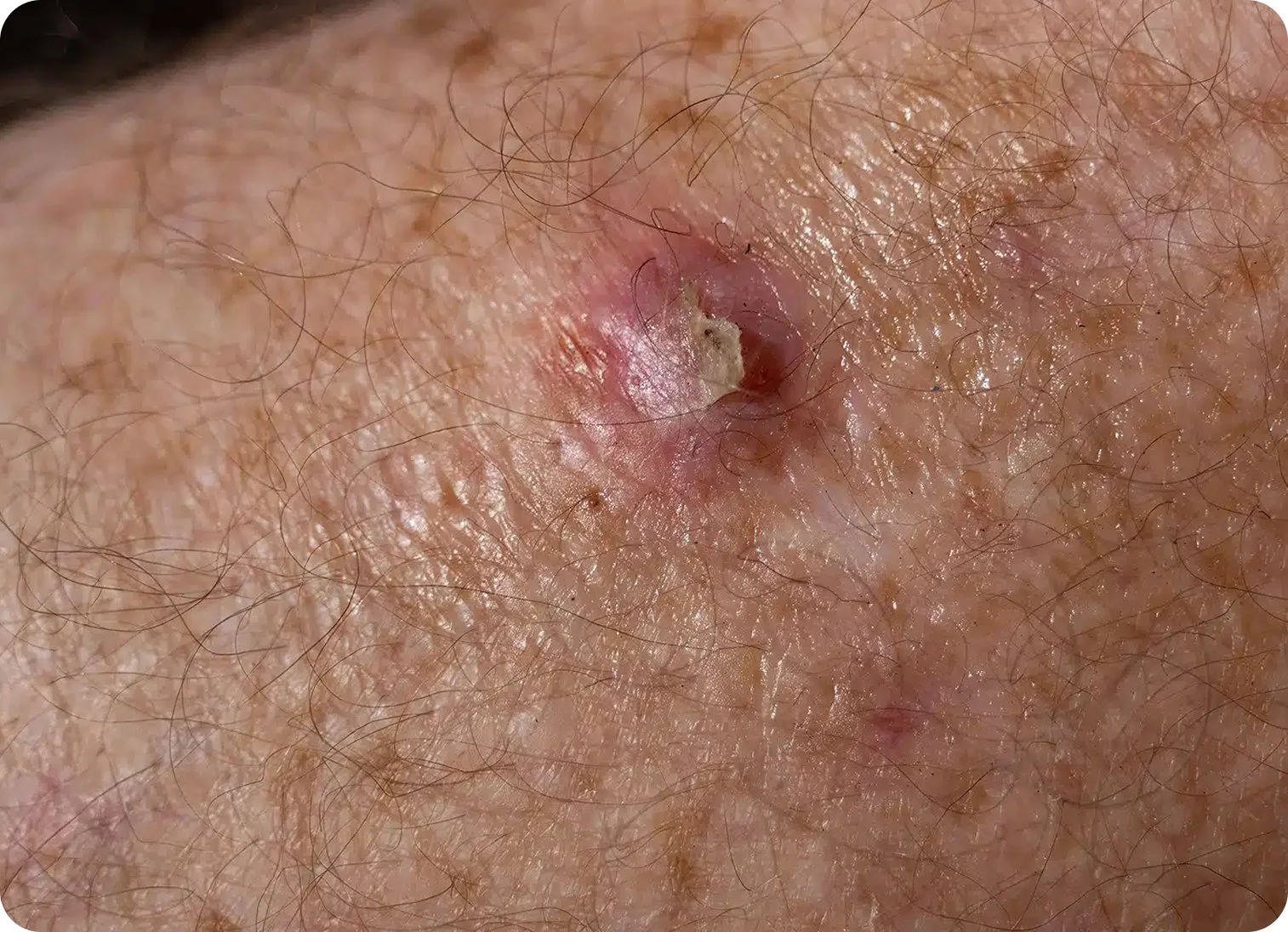 Close-up of human skin with hair follicles and a pimple or cyst that appears to be infected.