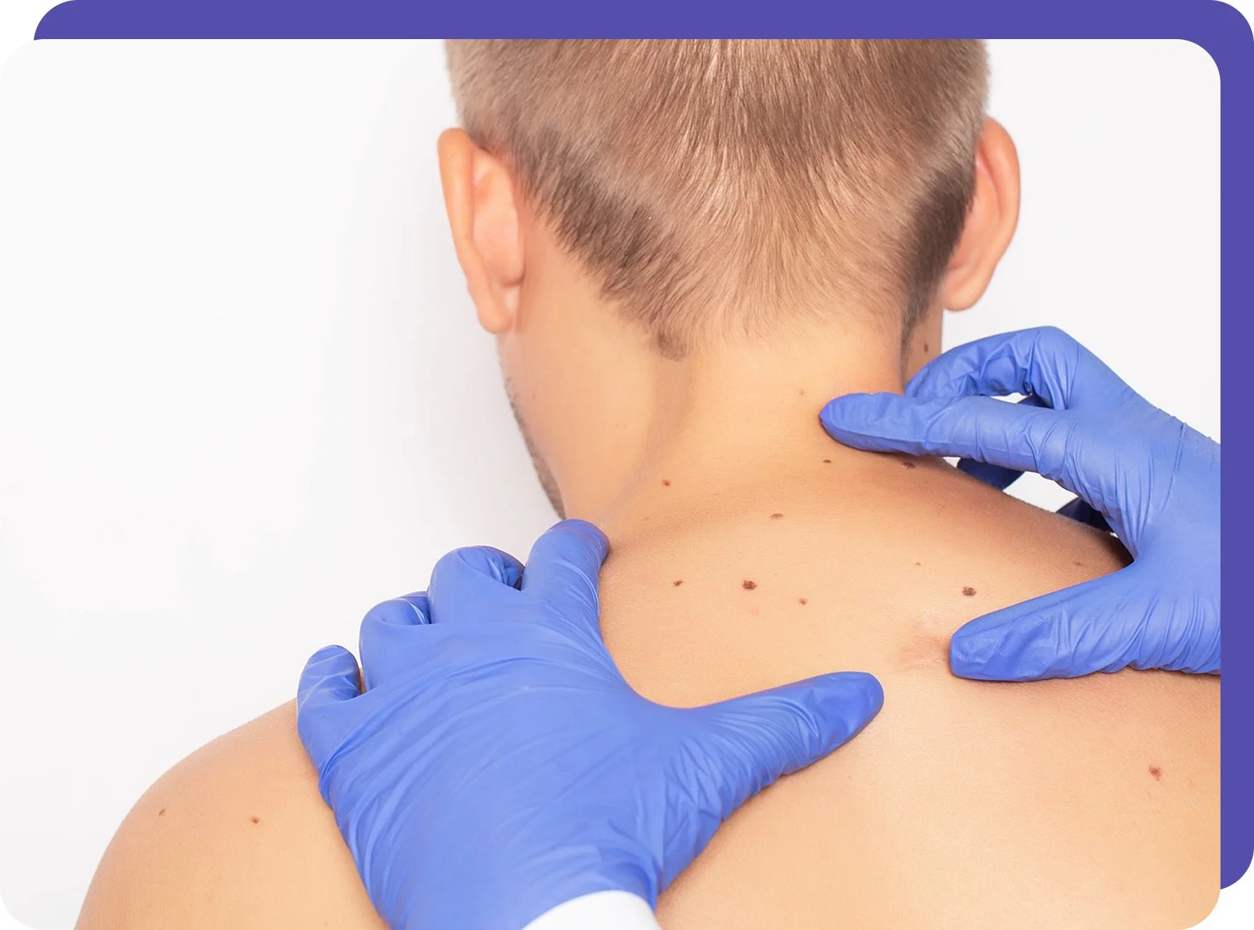 A person with short blond hair receives an acupuncture treatment on the back of their neck, performed by a healthcare professional wearing blue gloves.