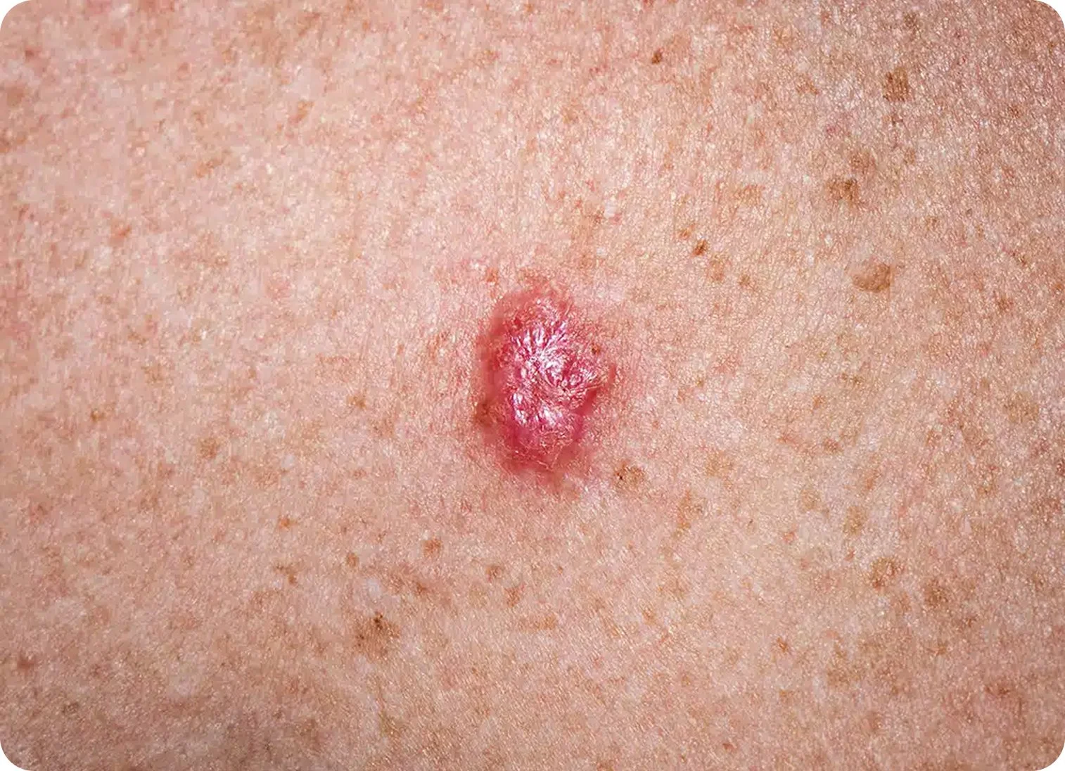 Close-up of a person's skin with a small, inflamed, and blistered skin lesion that appears red and shiny.