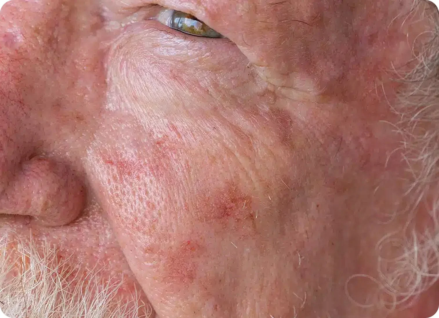 Close-up of a person's cheek and ear, showing skin with redness, irritation, and some small blemishes.