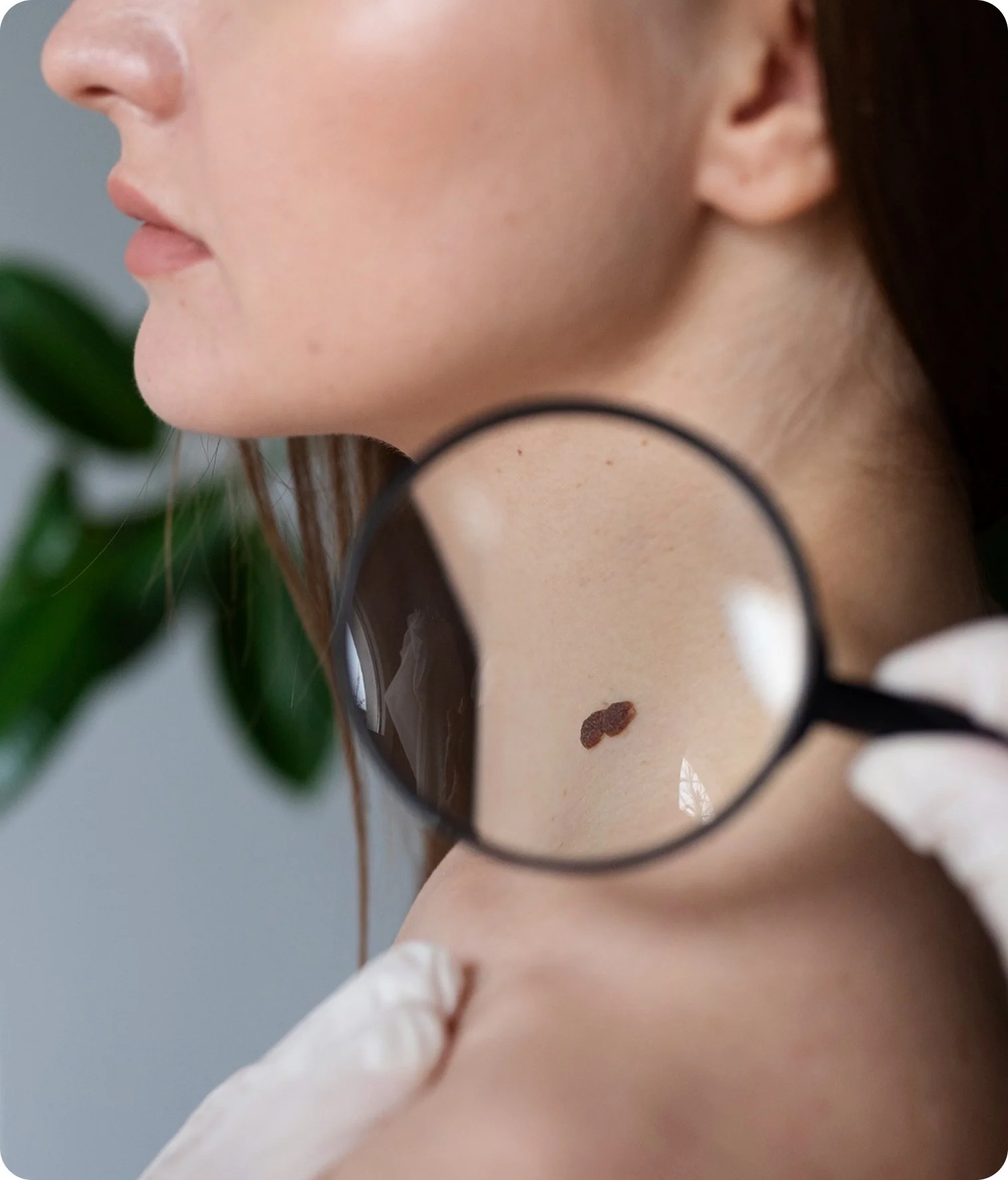 Close-up of a woman with fair skin holding a magnifying glass to her neck, revealing a small brown mole, with greenery in the background.